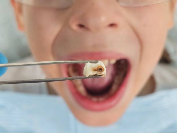 Best Emergency Treatment for Dental Infections or Abscesses in Harbor Hills, OH